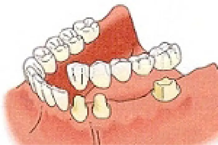 ブリッジ治療　イメージ
