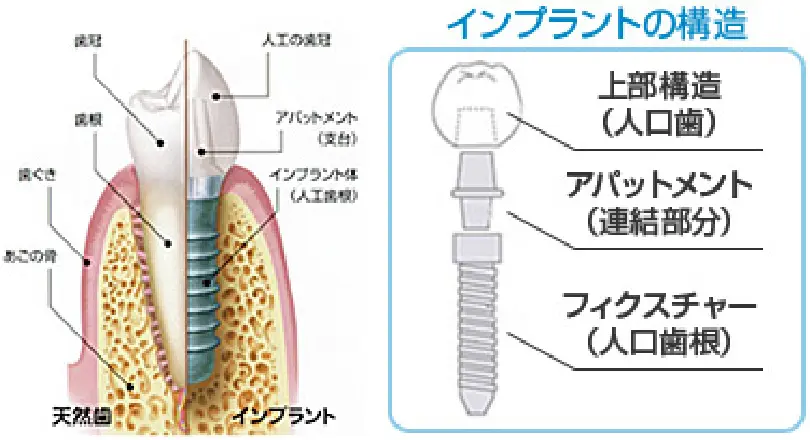 インプラントの構造　図解