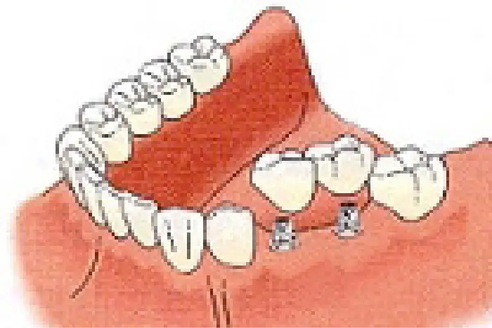 インプラント治療　イメージ