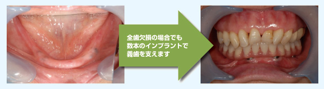 全歯欠損の場合でも、数本のインプラントで義歯を支えます