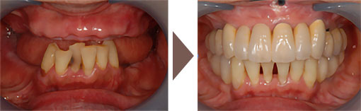 かみ合わせ治療によって改善された口腔内