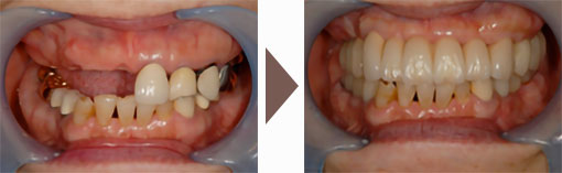 かみ合わせ治療によって改善された口腔内2