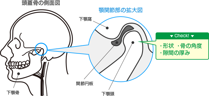 顎関節CT検査