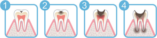 虫歯・歯周病の進行